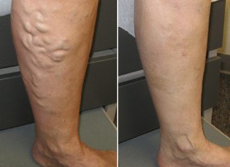 ČUDOTVORNI MELEM: Pomiješajte ova tri sastojka i proširene vene će nestati preko noći ČUDOTVORNI MELEM: Pomiješajte ova tri sastojka i proširene vene će nestati preko noći - featured image