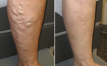 ČUDOTVORNI MELEM: Pomiješajte ova tri sastojka i proširene vene će nestati preko noći ČUDOTVORNI MELEM: Pomiješajte ova tri sastojka i proširene vene će nestati preko noći - featured image