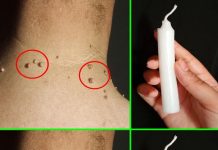 Probala sam sve moguće recepte da se otarasim bradavica, a rešenje sam pronašla u 5 potpuno prirodnih sastojaka koje svi imamo kod kuće