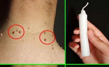 Probala sam sve moguće recepte da se otarasim bradavica, a rešenje sam pronašla u 5 potpuno prirodnih sastojaka koje svi imamo kod kuće