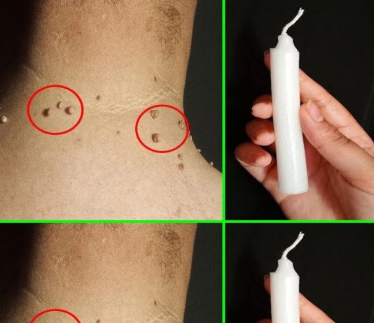 Probala sam sve moguće recepte da se otarasim bradavica, a rešenje sam pronašla u 5 potpuno prirodnih sastojaka koje svi imamo kod kuće