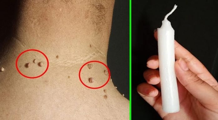 Probala sam sve moguće recepte da se otarasim bradavica, a rešenje sam pronašla u 5 potpuno prirodnih sastojaka koje svi imamo kod kuće