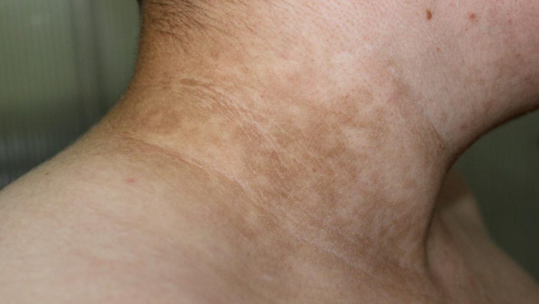 Ukoliko primetite ove TAMNE FLEKE na vratu, obavezno zakažite PREGLED! Doktor kaže da može biti SIMPTOM opake BOLESTI - featured image