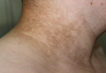 Ukoliko primetite ove TAMNE FLEKE na vratu, obavezno zakažite PREGLED! Doktor kaže da može biti SIMPTOM opake BOLESTI Ukoliko primetite ove TAMNE FLEKE na vratu, obavezno zakažite PREGLED! Doktor kaže da može biti SIMPTOM opake BOLESTI - featured image