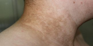 Ukoliko primetite ove TAMNE FLEKE na vratu, obavezno zakažite PREGLED! Doktor kaže da može biti SIMPTOM opake BOLESTI Ukoliko primetite ove TAMNE FLEKE na vratu, obavezno zakažite PREGLED! Doktor kaže da može biti SIMPTOM opake BOLESTI - featured image