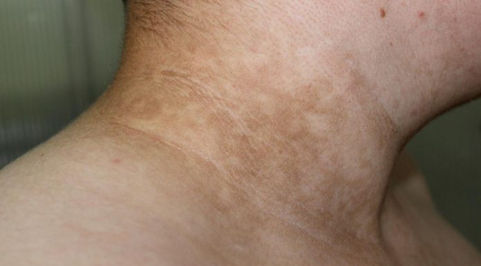 Ukoliko primetite ove TAMNE FLEKE na vratu, obavezno zakažite PREGLED! Doktor kaže da može biti SIMPTOM opake BOLESTI Ukoliko primetite ove TAMNE FLEKE na vratu, obavezno zakažite PREGLED! Doktor kaže da može biti SIMPTOM opake BOLESTI - featured image