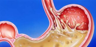 GUŠI VAS KISELINA U ŽELUCU – RIJEŠITE SE GORUŠICE I PODRIGIVANJA NA PRIRODAN NAČIN: Treba vam samo 1 namirnica GUŠI VAS KISELINA U ŽELUCU - RIJEŠITE SE GORUŠICE I PODRIGIVANJA NA PRIRODAN NAČIN: Treba vam samo 1 namirnica - featured image