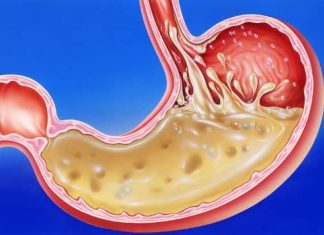 GUŠI VAS KISELINA U ŽELUCU – RIJEŠITE SE GORUŠICE I PODRIGIVANJA NA PRIRODAN NAČIN: Treba vam samo 1 namirnica GUŠI VAS KISELINA U ŽELUCU - RIJEŠITE SE GORUŠICE I PODRIGIVANJA NA PRIRODAN NAČIN: Treba vam samo 1 namirnica - featured image