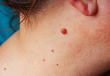 IMATE LI VISEĆE MLADEŽE NA KOŽI? POSTOJI PRIRODAN NAČIN DA IH ODSTRANITE: Trik koji malo ko zna, JEDNOSTAVNO IMATE LI VISEĆE MLADEŽE NA KOŽI? POSTOJI PRIRODAN NAČIN DA IH ODSTRANITE: Trik koji malo ko zna, JEDNOSTAVNO - featured image