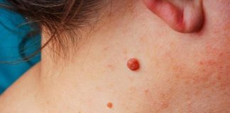 IMATE LI VISEĆE MLADEŽE NA KOŽI? POSTOJI PRIRODAN NAČIN DA IH ODSTRANITE: Trik koji malo ko zna, JEDNOSTAVNO IMATE LI VISEĆE MLADEŽE NA KOŽI? POSTOJI PRIRODAN NAČIN DA IH ODSTRANITE: Trik koji malo ko zna, JEDNOSTAVNO - featured image