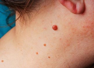 IMATE LI VISEĆE MLADEŽE NA KOŽI? POSTOJI PRIRODAN NAČIN DA IH ODSTRANITE: Trik koji malo ko zna, JEDNOSTAVNO IMATE LI VISEĆE MLADEŽE NA KOŽI? POSTOJI PRIRODAN NAČIN DA IH ODSTRANITE: Trik koji malo ko zna, JEDNOSTAVNO - featured image