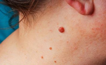 IMATE LI VISEĆE MLADEŽE NA KOŽI? POSTOJI PRIRODAN NAČIN DA IH ODSTRANITE: Trik koji malo ko zna, JEDNOSTAVNO IMATE LI VISEĆE MLADEŽE NA KOŽI? POSTOJI PRIRODAN NAČIN DA IH ODSTRANITE: Trik koji malo ko zna, JEDNOSTAVNO - featured image