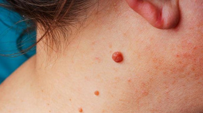 IMATE LI VISEĆE MLADEŽE NA KOŽI? POSTOJI PRIRODAN NAČIN DA IH ODSTRANITE: Trik koji malo ko zna, JEDNOSTAVNO IMATE LI VISEĆE MLADEŽE NA KOŽI? POSTOJI PRIRODAN NAČIN DA IH ODSTRANITE: Trik koji malo ko zna, JEDNOSTAVNO - featured image