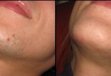 ZNATE LI ZAŠTO SE KOD ŽENA JAVLJAJU DLAKE NA BRADI? Ovako vas organizam upozorava ZNATE LI ZAŠTO SE KOD ŽENA JAVLJAJU DLAKE NA BRADI? Ovako vas organizam upozorava - featured image