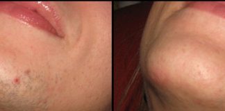 ZNATE LI ZAŠTO SE KOD ŽENA JAVLJAJU DLAKE NA BRADI? Ovako vas organizam upozorava ZNATE LI ZAŠTO SE KOD ŽENA JAVLJAJU DLAKE NA BRADI? Ovako vas organizam upozorava - featured image