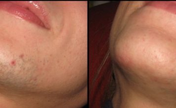 ZNATE LI ZAŠTO SE KOD ŽENA JAVLJAJU DLAKE NA BRADI? Ovako vas organizam upozorava ZNATE LI ZAŠTO SE KOD ŽENA JAVLJAJU DLAKE NA BRADI? Ovako vas organizam upozorava - featured image