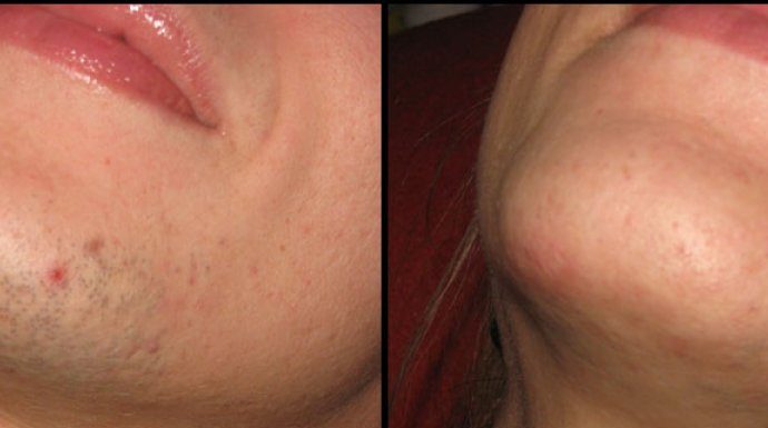 ZNATE LI ZAŠTO SE KOD ŽENA JAVLJAJU DLAKE NA BRADI? Ovako vas organizam upozorava ZNATE LI ZAŠTO SE KOD ŽENA JAVLJAJU DLAKE NA BRADI? Ovako vas organizam upozorava - featured image