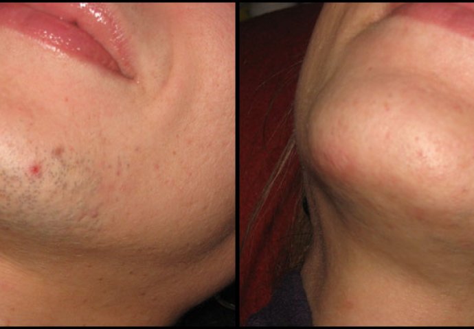 ZNATE LI ZAŠTO SE KOD ŽENA JAVLJAJU DLAKE NA BRADI? Ovako vas organizam upozorava - featured image ZNATE LI ZAŠTO SE KOD ŽENA JAVLJAJU DLAKE NA BRADI? Ovako vas organizam upozorava - featured image