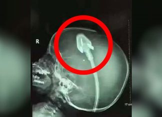 Dječakov rendgen je šokirao doktore diljem svijeta: Sad njegovi roditelji upozoravaju druge! (VIDEO) Dječakov rendgen je šokirao doktore diljem svijeta: Sad njegovi roditelji upozoravaju druge! (VIDEO) - featured image