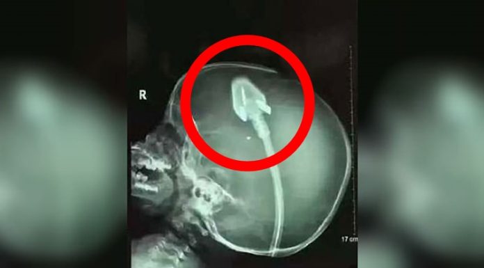 Dječakov rendgen je šokirao doktore diljem svijeta: Sad njegovi roditelji upozoravaju druge! (VIDEO) Dječakov rendgen je šokirao doktore diljem svijeta: Sad njegovi roditelji upozoravaju druge! (VIDEO) - featured image