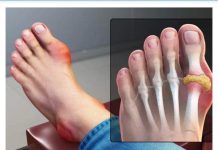 IZBACITE MOKRAĆNU KISELINU IZ TIJELA, IZBACITE GIHT: 3 Narodna Lijeka Koja Provjereno Djeluju, OVO ĆE VAM POMOĆI! (RECEPT) IZBACITE MOKRAĆNU KISELINU IZ TIJELA, IZBACITE GIHT: 3 Narodna Lijeka Koja Provjereno Djeluju, OVO ĆE VAM POMOĆI! (RECEPT) - featured image