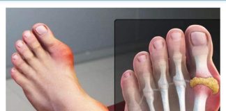 IZBACITE MOKRAĆNU KISELINU IZ TIJELA, IZBACITE GIHT: 3 Narodna Lijeka Koja Provjereno Djeluju, OVO ĆE VAM POMOĆI! (RECEPT) IZBACITE MOKRAĆNU KISELINU IZ TIJELA, IZBACITE GIHT: 3 Narodna Lijeka Koja Provjereno Djeluju, OVO ĆE VAM POMOĆI! (RECEPT) - featured image