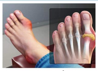 IZBACITE MOKRAĆNU KISELINU IZ TIJELA, IZBACITE GIHT: 3 Narodna Lijeka Koja Provjereno Djeluju, OVO ĆE VAM POMOĆI! (RECEPT) IZBACITE MOKRAĆNU KISELINU IZ TIJELA, IZBACITE GIHT: 3 Narodna Lijeka Koja Provjereno Djeluju, OVO ĆE VAM POMOĆI! (RECEPT) - featured image