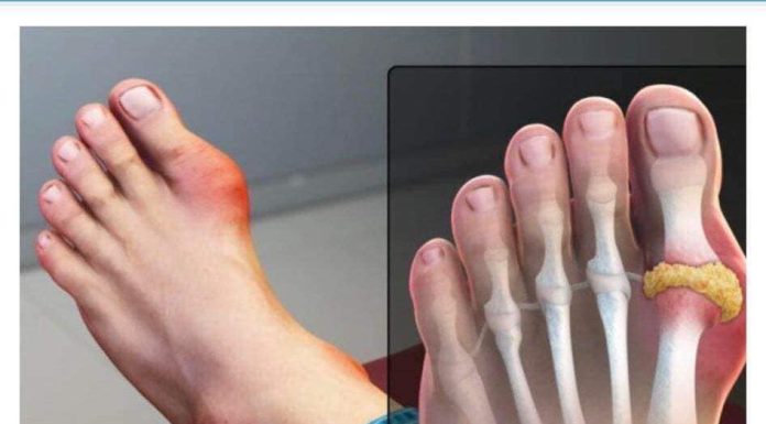 IZBACITE MOKRAĆNU KISELINU IZ TIJELA, IZBACITE GIHT: 3 Narodna Lijeka Koja Provjereno Djeluju, OVO ĆE VAM POMOĆI! (RECEPT) IZBACITE MOKRAĆNU KISELINU IZ TIJELA, IZBACITE GIHT: 3 Narodna Lijeka Koja Provjereno Djeluju, OVO ĆE VAM POMOĆI! (RECEPT) - featured image