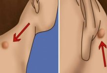 POJAVILA VAM SE KVRŽICA NA VRATU, LEĐIMA ILI IZA UHA? Evo šta to znači! POJAVILA VAM SE KVRŽICA NA VRATU, LEĐIMA ILI IZA UHA? Evo šta to znači! - featured image
