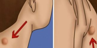 POJAVILA VAM SE KVRŽICA NA VRATU, LEĐIMA ILI IZA UHA? Evo šta to znači! POJAVILA VAM SE KVRŽICA NA VRATU, LEĐIMA ILI IZA UHA? Evo šta to znači! - featured image