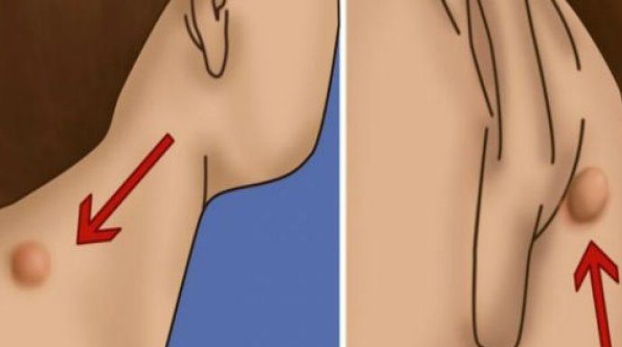 POJAVILA VAM SE KVRŽICA NA VRATU, LEĐIMA ILI IZA UHA? Evo šta to znači! POJAVILA VAM SE KVRŽICA NA VRATU, LEĐIMA ILI IZA UHA? Evo šta to znači! - featured image