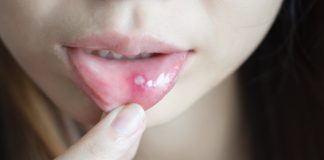Muče vas afte u ustima? Evo zašto nastaju i kako se riješiti neugodne boli Muče vas afte u ustima? Evo zašto nastaju i kako se riješiti neugodne boli - featured image