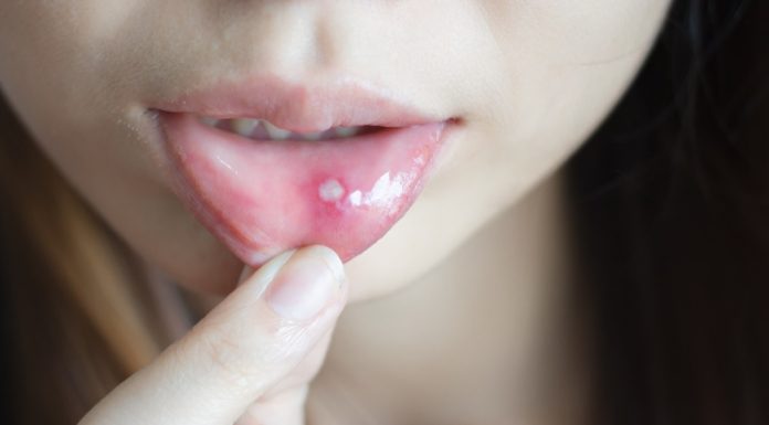 Muče vas afte u ustima? Evo zašto nastaju i kako se riješiti neugodne boli Muče vas afte u ustima? Evo zašto nastaju i kako se riješiti neugodne boli - featured image
