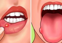 Pojavljuju li se i vama u ustima ovakve rane? Evo šta vam organizam poručuje, ODMAH MORATE OVO URADITI Pojavljuju li se i vama u ustima ovakve rane? Evo šta vam organizam poručuje, ODMAH MORATE OVO URADITI - featured image