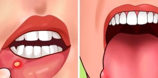 Pojavljuju li se i vama u ustima ovakve rane? Evo šta vam organizam poručuje, ODMAH MORATE OVO URADITI Pojavljuju li se i vama u ustima ovakve rane? Evo šta vam organizam poručuje, ODMAH MORATE OVO URADITI - featured image