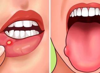 Pojavljuju li se i vama u ustima ovakve rane? Evo šta vam organizam poručuje, ODMAH MORATE OVO URADITI Pojavljuju li se i vama u ustima ovakve rane? Evo šta vam organizam poručuje, ODMAH MORATE OVO URADITI - featured image