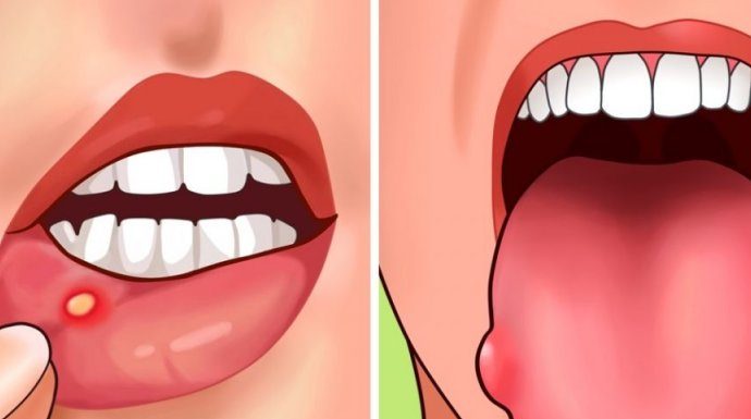 Pojavljuju li se i vama u ustima ovakve rane? Evo šta vam organizam poručuje, ODMAH MORATE OVO URADITI Pojavljuju li se i vama u ustima ovakve rane? Evo šta vam organizam poručuje, ODMAH MORATE OVO URADITI - featured image