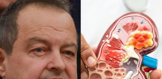 Ivica Dačić ne boluje samo od upale pluća, ovu bolest je ignorisao godinama, a tiho razara organe Ivica Dačić ne boluje samo od upale pluća, ovu bolest je ignorisao godinama, a tiho razara organe - featured image