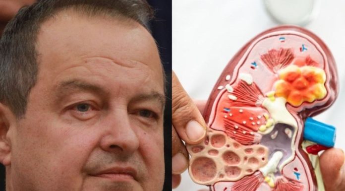 Ivica Dačić ne boluje samo od upale pluća, ovu bolest je ignorisao godinama, a tiho razara organe Ivica Dačić ne boluje samo od upale pluća, ovu bolest je ignorisao godinama, a tiho razara organe - featured image