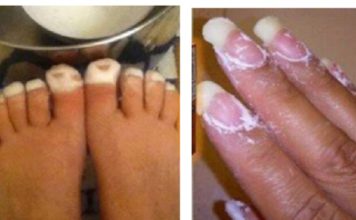 Nikako nisam mogla ukloniti gljivice s noktiju, sve dok nisam namazala OVO Nikako nisam mogla ukloniti gljivice s noktiju, sve dok nisam namazala OVO - featured image