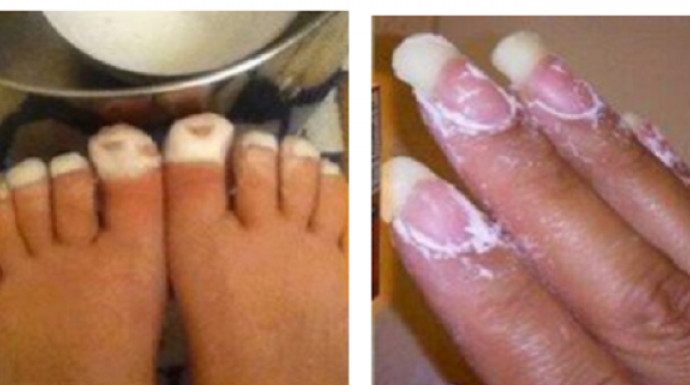 Nikako nisam mogla ukloniti gljivice s noktiju, sve dok nisam namazala OVO Nikako nisam mogla ukloniti gljivice s noktiju, sve dok nisam namazala OVO - featured image