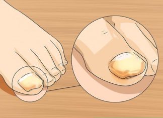 SINOĆ SAM NAMAZALA OVU SMJESU NA GLJIVICE NA NOKTIMA: One su nestale kao rukom odnešene, GENIJALAN RECEPT MI SPASIO ŽIVOT SINOĆ SAM NAMAZALA OVU SMJESU NA GLJIVICE NA NOKTIMA: One su nestale kao rukom odnešene, GENIJALAN RECEPT MI SPASIO ŽIVOT - featured image