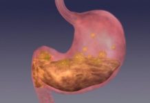 BOLJI LIJEK ZA GASTRITIS OD OVOG NE POSTOJI: Bolovi u želucu nestaju već nakon prve čaše! (ZAPIŠITE RECEPT) BOLJI LIJEK ZA GASTRITIS OD OVOG NE POSTOJI: Bolovi u želucu nestaju već nakon prve čaše! (ZAPIŠITE RECEPT) - featured image