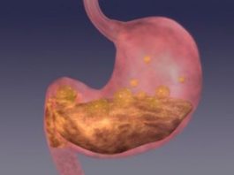 BOLJI LIJEK ZA GASTRITIS OD OVOG NE POSTOJI: Bolovi u želucu nestaju već nakon prve čaše! (ZAPIŠITE RECEPT) BOLJI LIJEK ZA GASTRITIS OD OVOG NE POSTOJI: Bolovi u želucu nestaju već nakon prve čaše! (ZAPIŠITE RECEPT) - featured image