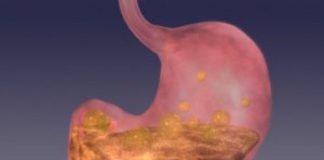 BOLJI LIJEK ZA GASTRITIS OD OVOG NE POSTOJI: Bolovi u želucu nestaju već nakon prve čaše! (ZAPIŠITE RECEPT) BOLJI LIJEK ZA GASTRITIS OD OVOG NE POSTOJI: Bolovi u želucu nestaju već nakon prve čaše! (ZAPIŠITE RECEPT) - featured image