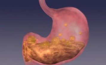 BOLJI LIJEK ZA GASTRITIS OD OVOG NE POSTOJI: Bolovi u želucu nestaju već nakon prve čaše! (ZAPIŠITE RECEPT) BOLJI LIJEK ZA GASTRITIS OD OVOG NE POSTOJI: Bolovi u želucu nestaju već nakon prve čaše! (ZAPIŠITE RECEPT) - featured image