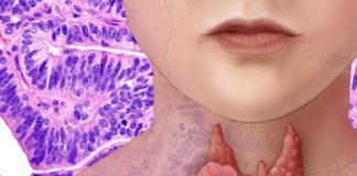 AKO IMATE PROBLEM SA ŠTITNOM ŽLIJEZDOM, OVE 2 NAMIRNICE IZBACITE: Štitna žlijezda ih nikako ne voli AKO IMATE PROBLEM SA ŠTITNOM ŽLIJEZDOM, OVE 2 NAMIRNICE IZBACITE: Štitna žlijezda ih nikako ne voli - featured image