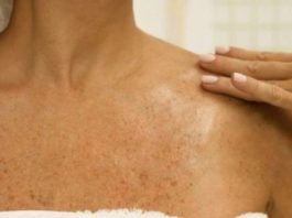 SMEĐE MRLJE SU ČESTE PO TIJELU, ALI POSTOJI NAČIN KAKO DA IH UKLONITE: Dermatolog otkrio tajnu, smjesa ova dva sastojka čini čuda! SMEĐE MRLJE SU ČESTE PO TIJELU, ALI POSTOJI NAČIN KAKO DA IH UKLONITE: Dermatolog otkrio tajnu, smjesa ova dva sastojka čini čuda! - featured image