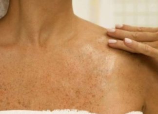 SMEĐE MRLJE SU ČESTE PO TIJELU, ALI POSTOJI NAČIN KAKO DA IH UKLONITE: Dermatolog otkrio tajnu, smjesa ova dva sastojka čini čuda! SMEĐE MRLJE SU ČESTE PO TIJELU, ALI POSTOJI NAČIN KAKO DA IH UKLONITE: Dermatolog otkrio tajnu, smjesa ova dva sastojka čini čuda! - featured image