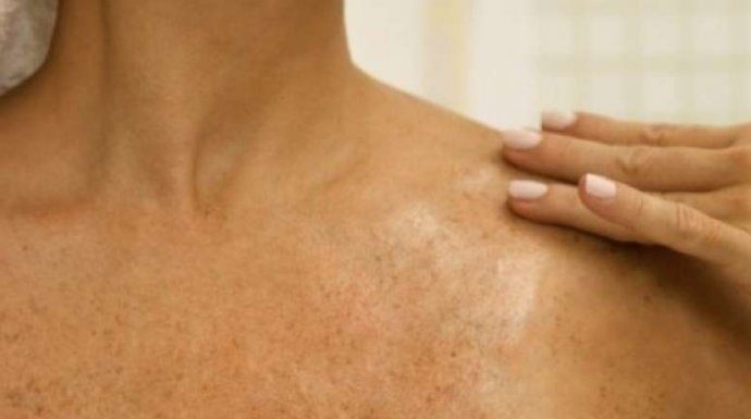 SMEĐE MRLJE SU ČESTE PO TIJELU, ALI POSTOJI NAČIN KAKO DA IH UKLONITE: Dermatolog otkrio tajnu, smjesa ova dva sastojka čini čuda! SMEĐE MRLJE SU ČESTE PO TIJELU, ALI POSTOJI NAČIN KAKO DA IH UKLONITE: Dermatolog otkrio tajnu, smjesa ova dva sastojka čini čuda! - featured image